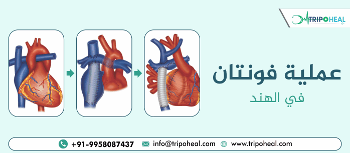 علاج عملية فونتان في الهند