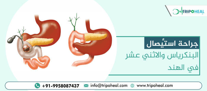 جراحة ويبل في الهند